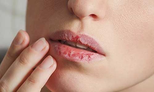 bibir pecah pecah